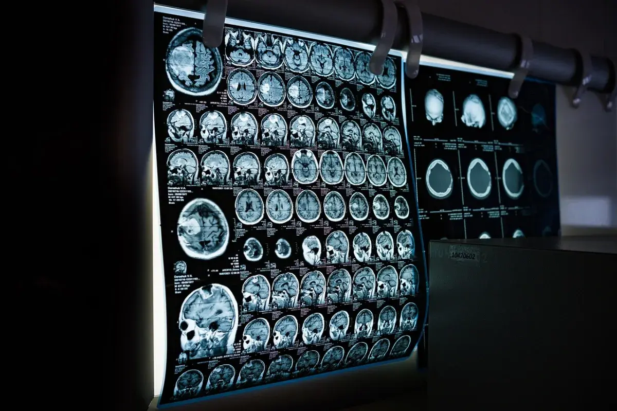 Gantenerumab Fails to Slow Alzheimer's Progression in Clinical Trials