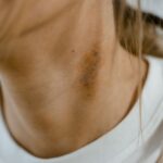 Detailed close-up image of a neck showing a visible bruise or scar, emphasizing skin texture.