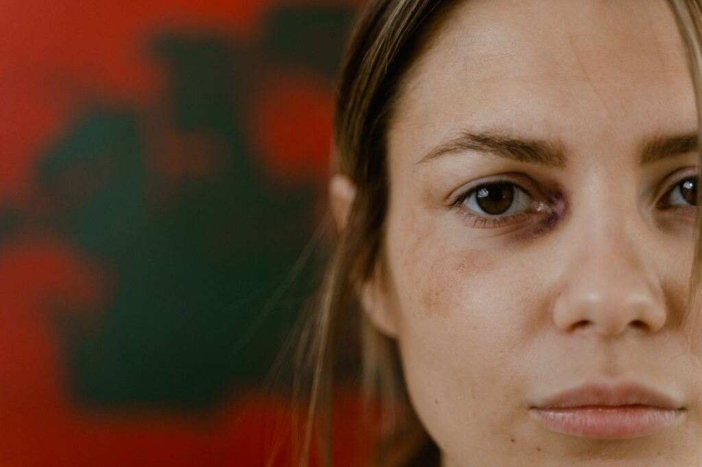 Close-up portrait of a woman with a bruised eye, depicting emotion and resilience.